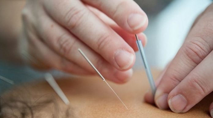 Caucasian hands putting acupuncture needles into person's back